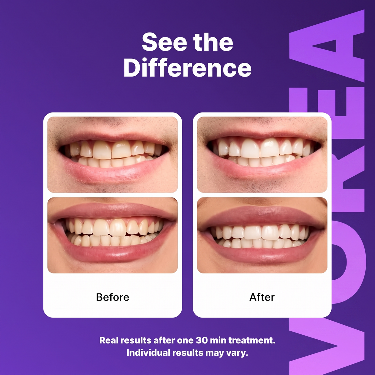 Vorea™ Purple Whitening Strips